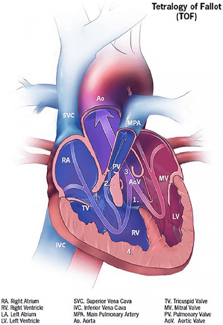 Тетрада фалло сердца. Тетралогия Фалло у детей. Тетрада Фалло анатомия. Тетралогия Фалло гемодинамика. Декстрапозиция аорты.