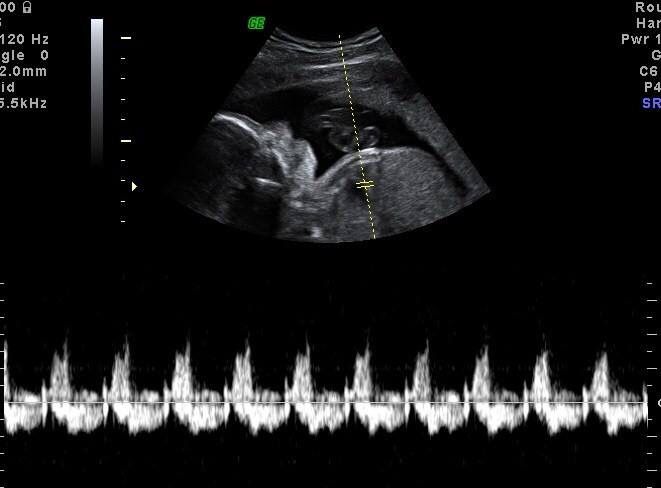 اولین صدای قلب جنین