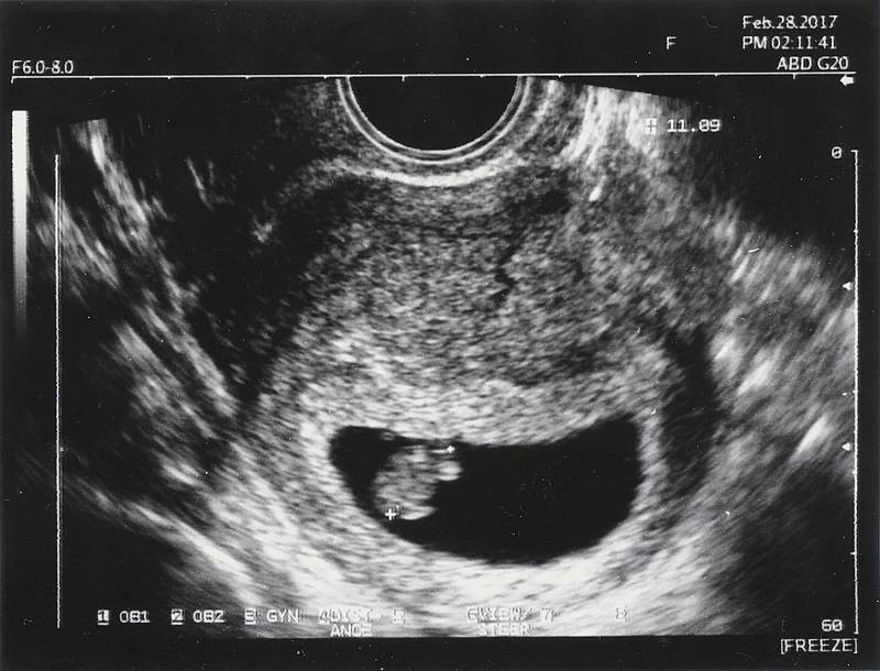 علائم مرگ جنین در سه ماهه اول بارداری